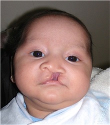 Cleft Lip and Palate Repair Before Photo by Rachel Ruotolo, MD; Garden City, NY - Case 38130