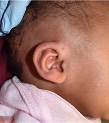 Ear Surgery After Photo by Rachel Ruotolo, MD; Garden City, NY - Case 38137