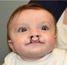 Cleft Lip and Palate Repair Before Photo by Rachel Ruotolo, MD; Garden City, NY - Case 38138