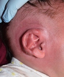 Ear Surgery After Photo by Rachel Ruotolo, MD; Garden City, NY - Case 38142