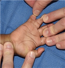 Hand Surgery for Congenital Differences Before Photo by Rachel Ruotolo, MD; Garden City, NY - Case 38296