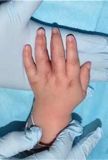 Hand Surgery for Congenital Differences After Photo by Rachel Ruotolo, MD; Garden City, NY - Case 38299