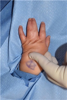 Hand Surgery for Congenital Differences Before Photo by Rachel Ruotolo, MD; Garden City, NY - Case 38299