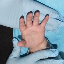 Hand Surgery for Congenital Differences After Photo by Rachel Ruotolo, MD; Garden City, NY - Case 38299