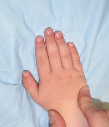 Hand Surgery for Congenital Differences After Photo by Rachel Ruotolo, MD; Garden City, NY - Case 38301