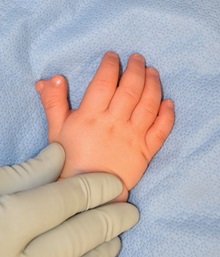 Hand Surgery for Congenital Differences Before Photo by Rachel Ruotolo, MD; Garden City, NY - Case 38301