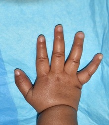Hand Surgery for Congenital Differences After Photo by Rachel Ruotolo, MD; Garden City, NY - Case 38302