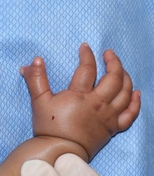 Hand Surgery for Congenital Differences Before Photo by Rachel Ruotolo, MD; Garden City, NY - Case 38302