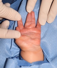Hand Surgery for Congenital Differences Before Photo by Rachel Ruotolo, MD; Garden City, NY - Case 38304