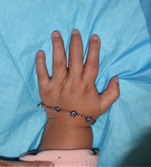 Hand Surgery for Congenital Differences After Photo by Rachel Ruotolo, MD; Garden City, NY - Case 38304