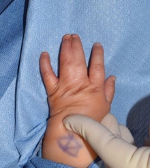 Hand Surgery for Congenital Differences Before Photo by Rachel Ruotolo, MD; Garden City, NY - Case 38304
