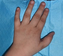 Hand Surgery for Congenital Differences After Photo by Rachel Ruotolo, MD; Garden City, NY - Case 38314