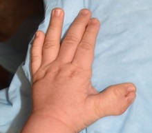 Hand Surgery for Congenital Differences Before Photo by Rachel Ruotolo, MD; Garden City, NY - Case 38314