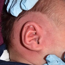 Ear Surgery After Photo by Rachel Ruotolo, MD; Garden City, NY - Case 38316