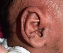 Ear Surgery After Photo by Rachel Ruotolo, MD; Garden City, NY - Case 38318