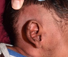 Ear Surgery Before Photo by Rachel Ruotolo, MD; Garden City, NY - Case 38318