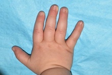 Hand Surgery for Congenital Differences After Photo by Rachel Ruotolo, MD; Garden City, NY - Case 40730