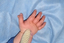 Hand Surgery for Congenital Differences Before Photo by Rachel Ruotolo, MD; Garden City, NY - Case 40730