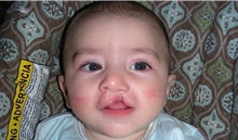 Cleft Lip and Palate Repair Before Photo by Rachel Ruotolo, MD; Garden City, NY - Case 40732