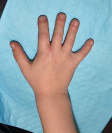 Hand Surgery for Congenital Differences After Photo by Rachel Ruotolo, MD; Garden City, NY - Case 40735