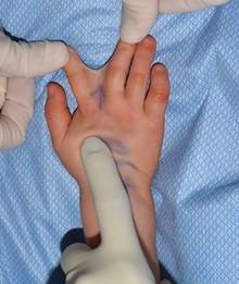 Hand Surgery for Congenital Differences Before Photo by Rachel Ruotolo, MD; Garden City, NY - Case 40735