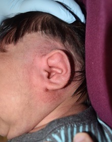 Ear Surgery After Photo by Rachel Ruotolo, MD; Garden City, NY - Case 40738