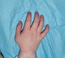 Hand Surgery for Congenital Differences After Photo by Rachel Ruotolo, MD; Garden City, NY - Case 41337