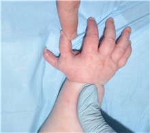 Hand Surgery for Congenital Differences Before Photo by Rachel Ruotolo, MD; Garden City, NY - Case 41337