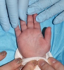 Hand Surgery for Congenital Differences After Photo by Rachel Ruotolo, MD; Garden City, NY - Case 41337