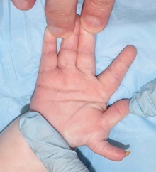 Hand Surgery for Congenital Differences Before Photo by Rachel Ruotolo, MD; Garden City, NY - Case 41337