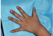 Hand Surgery for Congenital Differences After Photo by Rachel Ruotolo, MD; Garden City, NY - Case 41339