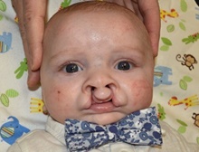 Cleft Lip and Palate Repair Before Photo by Rachel Ruotolo, MD; Garden City, NY - Case 41341