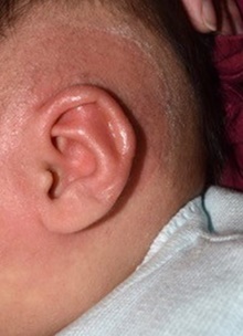 Ear Surgery After Photo by Rachel Ruotolo, MD; Garden City, NY - Case 41343