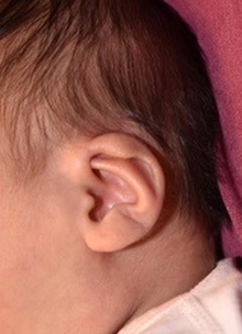 Ear Surgery Before Photo by Rachel Ruotolo, MD; Garden City, NY - Case 41343