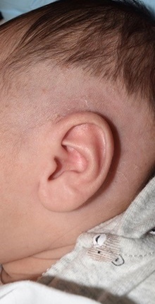 Ear Surgery After Photo by Rachel Ruotolo, MD; Garden City, NY - Case 41349
