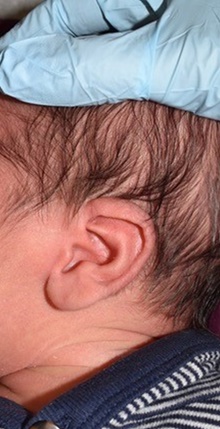 Ear Surgery Before Photo by Rachel Ruotolo, MD; Garden City, NY - Case 41349