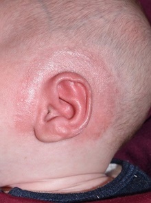 Ear Surgery After Photo by Rachel Ruotolo, MD; Garden City, NY - Case 41354