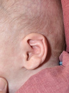 Ear Surgery Before Photo by Rachel Ruotolo, MD; Garden City, NY - Case 41354