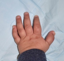 Hand Surgery for Congenital Differences After Photo by Rachel Ruotolo, MD; Garden City, NY - Case 41356