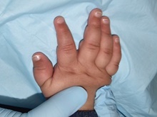 Hand Surgery for Congenital Differences After Photo by Rachel Ruotolo, MD; Garden City, NY - Case 41356