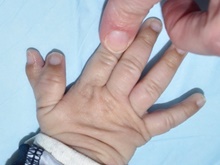 Hand Surgery for Congenital Differences Before Photo by Rachel Ruotolo, MD; Garden City, NY - Case 41356