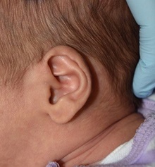 Ear Surgery Before Photo by Rachel Ruotolo, MD; Garden City, NY - Case 41357