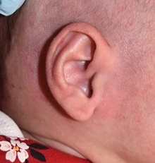 Ear Surgery After Photo by Rachel Ruotolo, MD; Garden City, NY - Case 41357