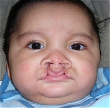 Cleft Lip and Palate Repair Before Photo by Rachel Ruotolo, MD; Garden City, NY - Case 41359