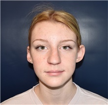 Ear Surgery Before Photo by Rachel Ruotolo, MD; Garden City, NY - Case 41361