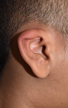 Ear Reconstruction Surgery Before Photo by Rachel Ruotolo, MD; Garden City, NY - Case 41362