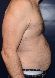 Male Breast Reduction After Photo by Rachel Ruotolo, MD; Garden City, NY - Case 41374