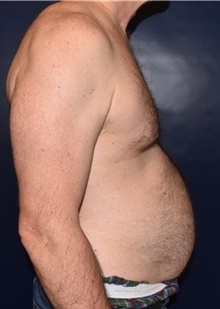 Male Breast Reduction Before Photo by Rachel Ruotolo, MD; Garden City, NY - Case 41374
