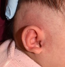 Ear Surgery After Photo by Rachel Ruotolo, MD; Garden City, NY - Case 41375