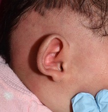 Ear Surgery Before Photo by Rachel Ruotolo, MD; Garden City, NY - Case 41375